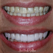 Velloso Odontologia - Facetas em Vitória