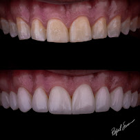 Dr. Rafael Sousa | Odontologia Estética e Lentes de Contato Dental