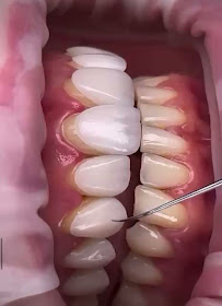 Dr. Rafael Sousa | Odontologia Estética e Lentes de Contato Dental