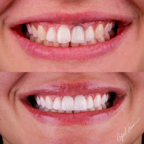Dr. Rafael Sousa | Odontologia Estética e Lentes de Contato Dental