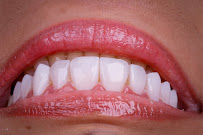 Dr. Rafael Sousa | Odontologia Estética e Lentes de Contato Dental