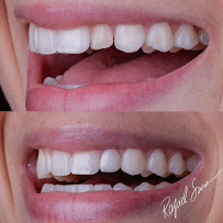 Dr. Rafael Sousa | Odontologia Estética e Lentes de Contato Dental