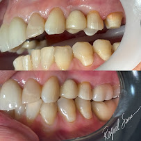 Dr. Rafael Sousa | Odontologia Estética e Lentes de Contato Dental