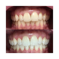 Dra. Ananda Jasson- Dentista. Tratamento de canal- Placa de bruxismo- Clareamento dental- Próteses - Implantes