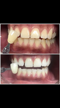 Dra. Ananda Jasson- Dentista. Tratamento de canal- Placa de bruxismo- Clareamento dental- Próteses - Implantes