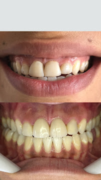 Dra. Ananda Jasson- Dentista. Tratamento de canal- Placa de bruxismo- Clareamento dental- Próteses - Implantes