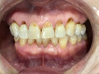 Dra. Ananda Jasson- Dentista. Tratamento de canal- Placa de bruxismo- Clareamento dental- Próteses - Implantes
