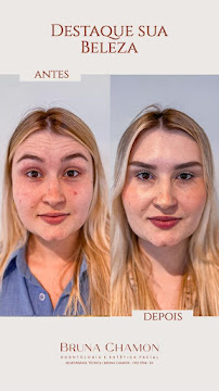 Bruna Chamon | Odontologia e Harmonização Facial