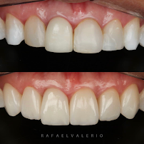 Oralle Studio Dental - Dentista Maringá - Invisalign