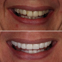 Oralle Studio Dental - Dentista Maringá - Invisalign