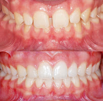 Oralle Studio Dental - Dentista Maringá - Invisalign