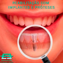 Dr. Eduardo F. Galbiati - Implantes dentários e Invisalign