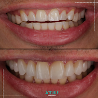 Attuale Odontologia - Facetas de Resina e Porcelana