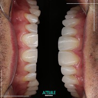 Attuale Odontologia - Facetas de Resina e Porcelana