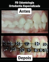 Dra. Jônia F. Bussmann - Ortodontista / Aparelhos Ortodônticos fixos / Aparelho estético / INVISALIGN / Dentista em Maringá