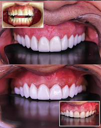 Dr. Beatriz Batista Odontologia | Lentes de Resina