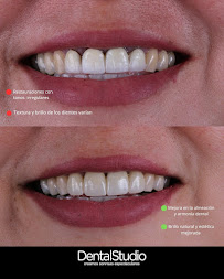 Implantes dentales | Dental Studio