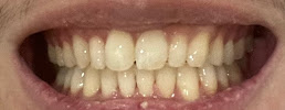 Shiny Smile Aesthetic Dental Clinic [Pasang Behel dan Implan Gigi]