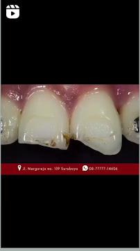 At Dentist Surabaya by drg Adip Natryo,Sp.KG - Endodontist & Orthodontist Surabaya Selatan