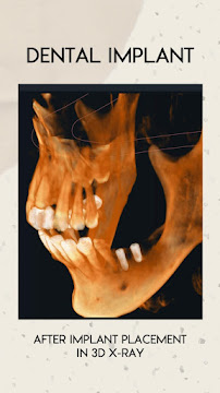 Dental Room PTC Implant and Esthetics