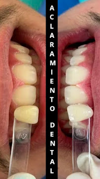 Diseño de Sonrisa | Blanqueamiento Dental | Veneers | Dental Implants