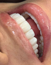 Diseño de Sonrisa | Blanqueamiento Dental | Veneers | Dental Implants