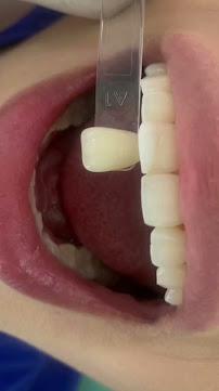 Diseño de Sonrisa | Blanqueamiento Dental | Veneers | Dental Implants