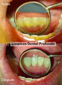 Diseño de Sonrisa | Blanqueamiento Dental | Veneers | Dental Implants