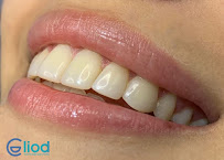Diseño de Sonrisa | Blanqueamiento Dental | Veneers | Dental Implants