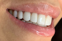 Diseño de Sonrisa | Blanqueamiento Dental | Veneers | Dental Implants
