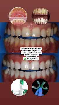 Diseño de Sonrisa | Blanqueamiento Dental | Veneers | Dental Implants