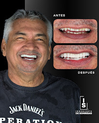 INGENIERÍA DE SONRISAS | SMILE DESIGN