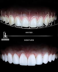 INGENIERÍA DE SONRISAS | SMILE DESIGN