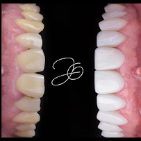 Dra Jen Ospina Estética Dental - Porcelain Veneers