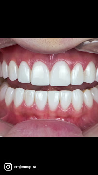 Dra Jen Ospina Estética Dental - Porcelain Veneers