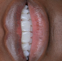 Dra Jen Ospina Estética Dental - Porcelain Veneers