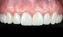 Dra Jen Ospina Estética Dental - Porcelain Veneers