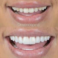 Dra Jen Ospina Estética Dental - Porcelain Veneers