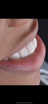 Dra Jen Ospina Estética Dental - Porcelain Veneers