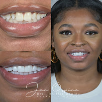 Dra Jen Ospina Estética Dental - Porcelain Veneers