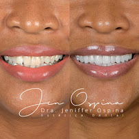 Dra Jen Ospina Estética Dental - Porcelain Veneers