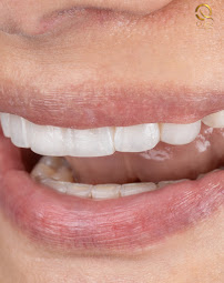 Diseño de sonrisa |Quiroz Dental | Odontologia
