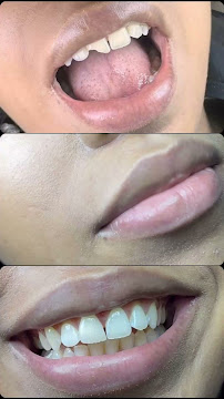 Diseño de sonrisa |Quiroz Dental | Odontologia