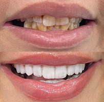 Veneers Dental Centre