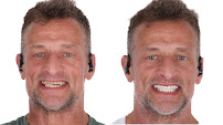 Novadent Dental Clinic - Dental Implants in los Algodones near Yuma AZ
