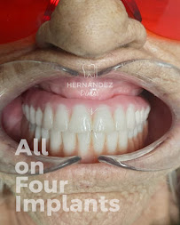 Hernandez Dental Implants