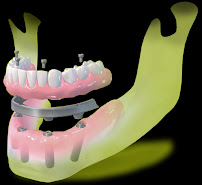 Hernandez Dental Implants