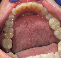 Dentist Algodones Mexico | Implants Crowns Zirconia | We accept Insurance Dental Ulloa