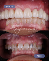 Dentist Los Algodones:Vivant Smile Design