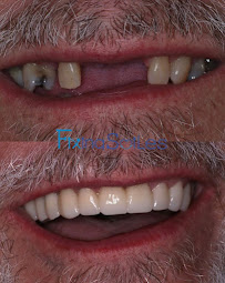 Fixing Smiles Los Algodones